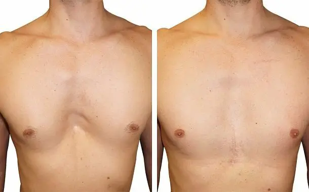 Pectus Excavatum Surgery Cost Updated 2023 The Pricer