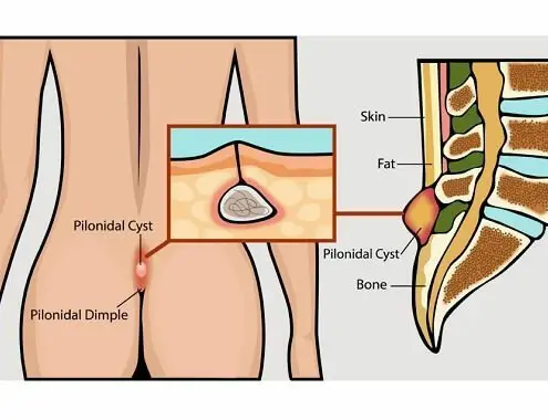 Pilonidal Cyst Surgery Cost