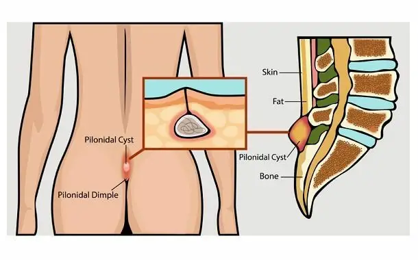 Pilonidal Cyst Surgery Cost