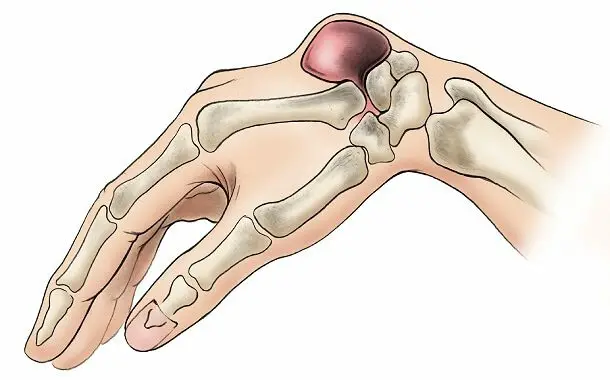 Ganglion Cyst Removal Cost