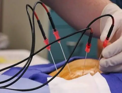 Radiofrequency Ablation Procedure Cost