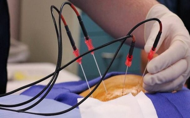 Radiofrequency Ablation Procedure Cost