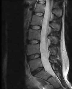 Lumbar MRI Cost