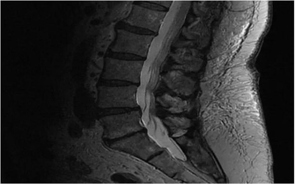 Lumbar MRI Picture