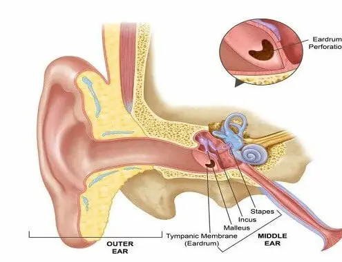 Perforated Eardrum Surgery Cost