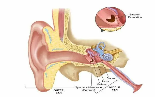 Perforated Eardrum Surgery Cost