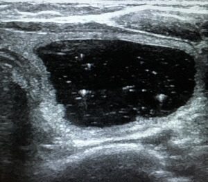 Thyroid Nodule