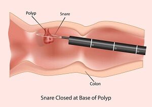 Colonoscopy Removing Polyps