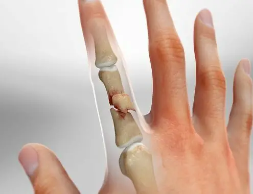Finger Surgery Cost