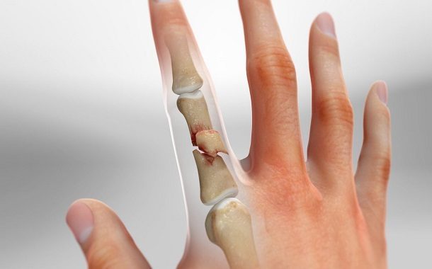 Finger Surgery Cost