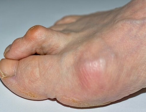 Hammer Toe Surgery Cost