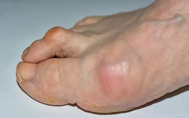 Hammer Toe Surgery Cost