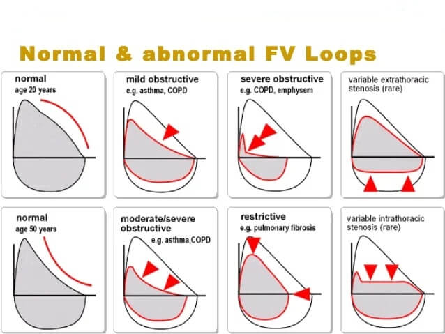 Pulmonary Function Testing