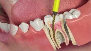 Root Canal Explained