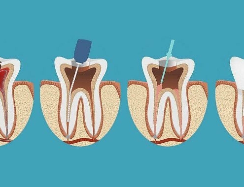 Root Canal Treatment Cost