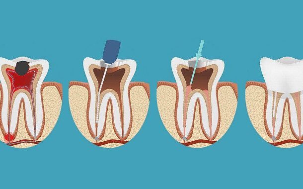 Root Canal Treatment Cost