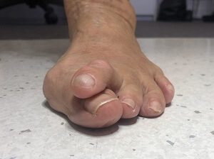 Ugly Hammer Toe