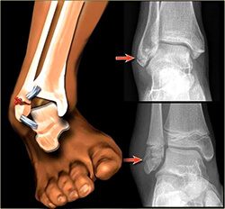 Ankle Fracture Repair