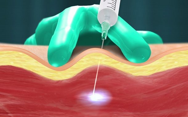 Trigger Point Injection Cost