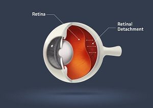 Signs of Retinal Detachment