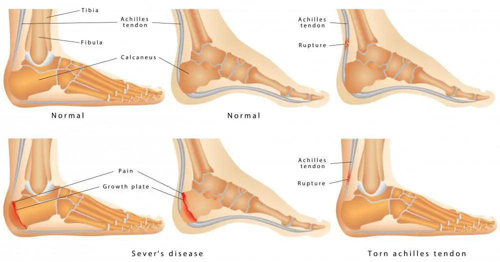Different Achile's Tendon Issues