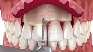 Gingivectomy Procedure Explained