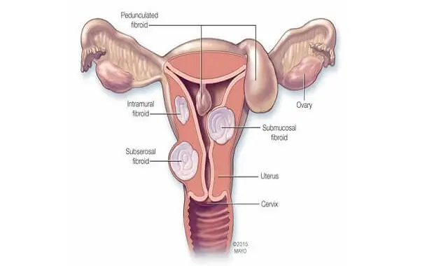 Fibroid Surgery Cost