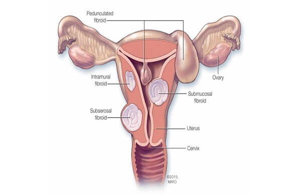 Fibroid Surgery Cost