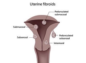 Fibroid Surgery Explained