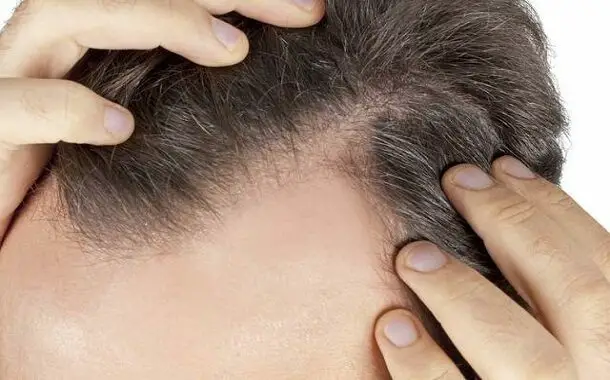 Hair Club for Men Cost