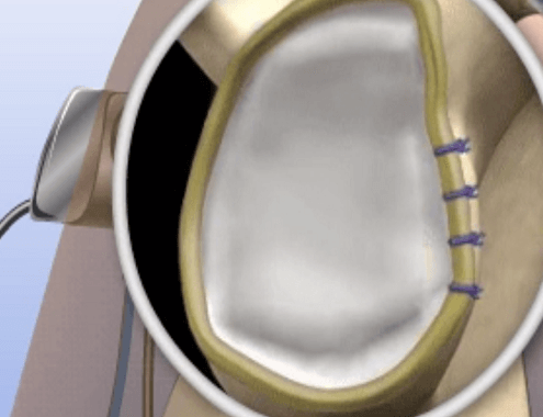 Slap Tear Surgery Cost Slap Tear Surgery Cost