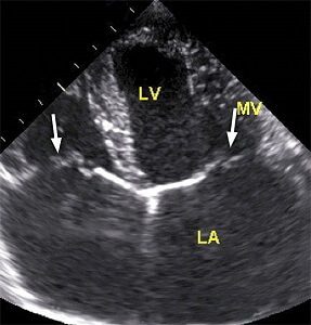 Heart Murmur on XRay