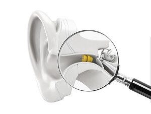 Phonak Lyric Inside Ear