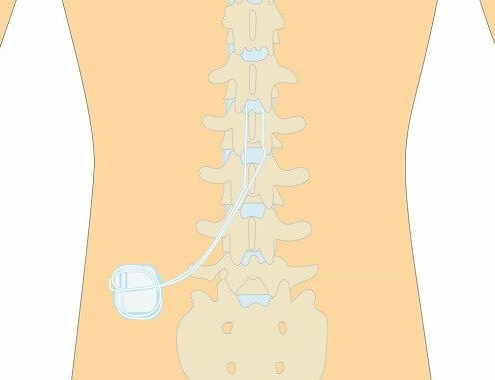 Spinal Cord Stimulator Cost