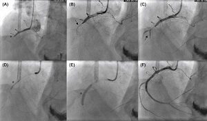 Coronary Angiogram Cost