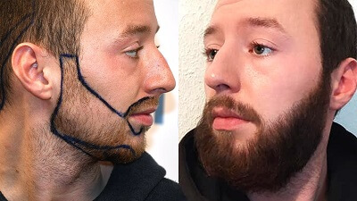 Beard Transplant Before and After