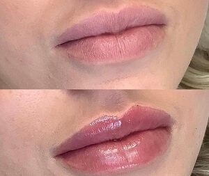 Lip Filler Before and After