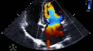 Echocardiocram Image