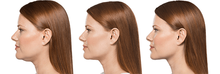 Kybella Before and After