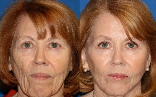 Facial Fat Transfer Cost Before and After