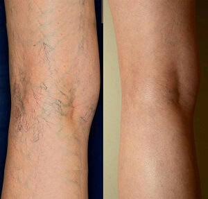 Sclerotherapy Before After