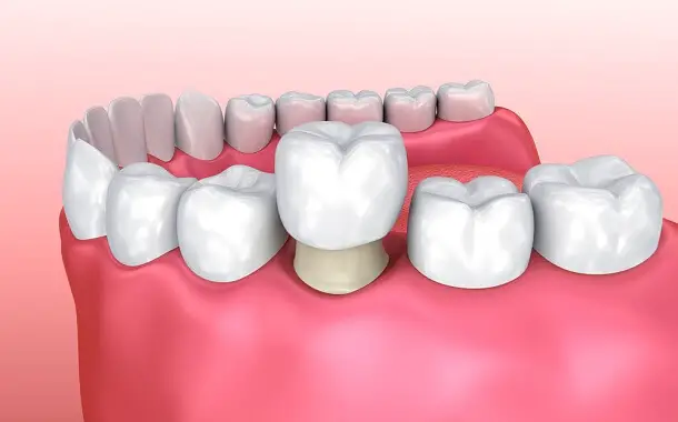 Cost to Reattach Dental Crown