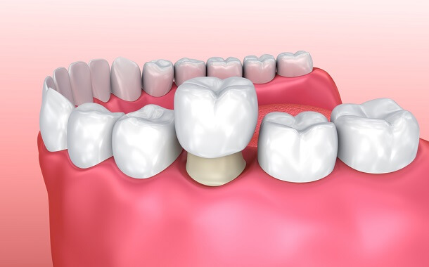 Cost to Reattach Dental Crown