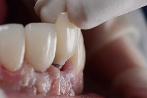 Detached Dental Crown