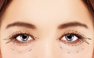Eyelid Surgery Explained