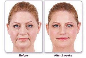 Juvederm Before After