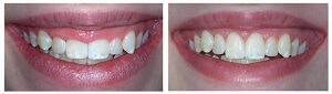 Crown Lengthening Before After