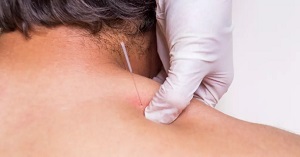 Dry Needling Shoulder