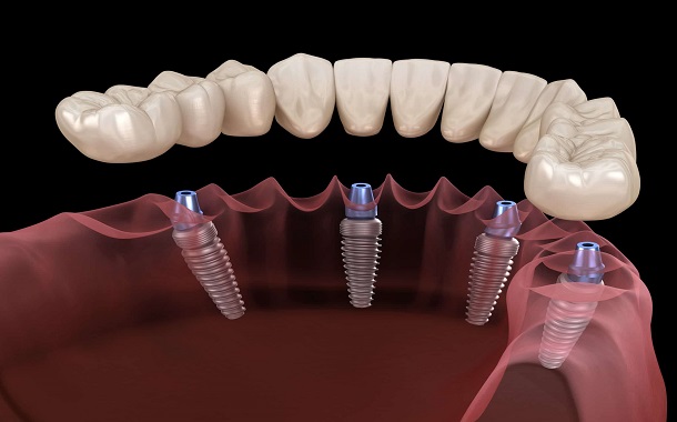 ClearChoice Dental Implant Cost