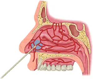 Nasal Cautery Explained